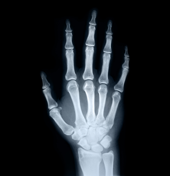 https://s34486.pcdn.co/wp-content/uploads/2020/02/hand-x-ray.jpg